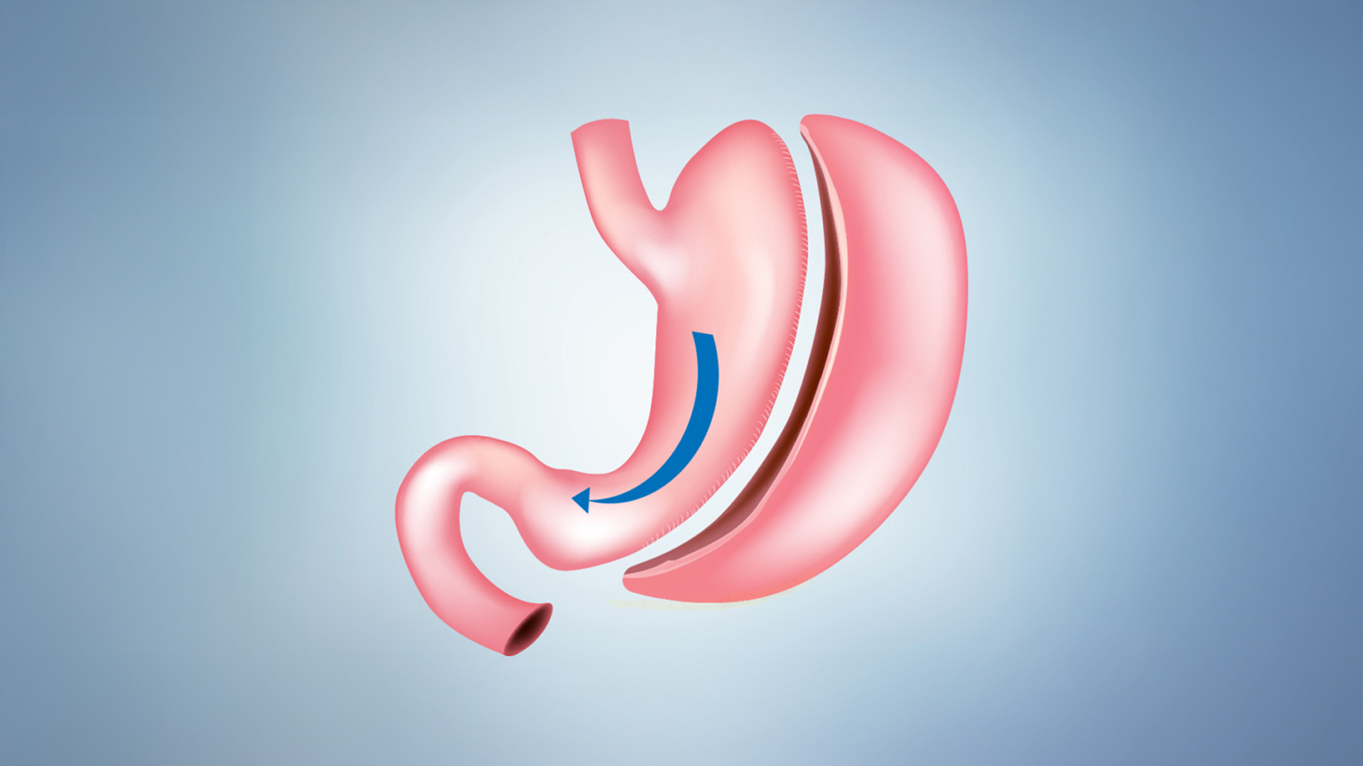 Gastric Sleeve