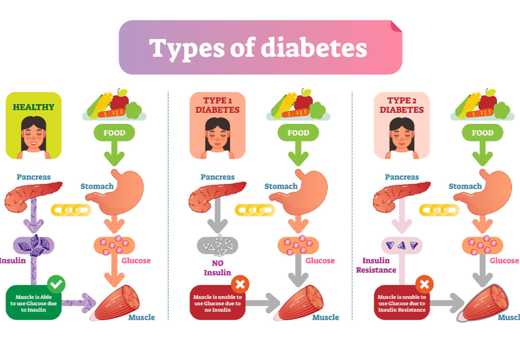 What Is Metabolic Surgery?