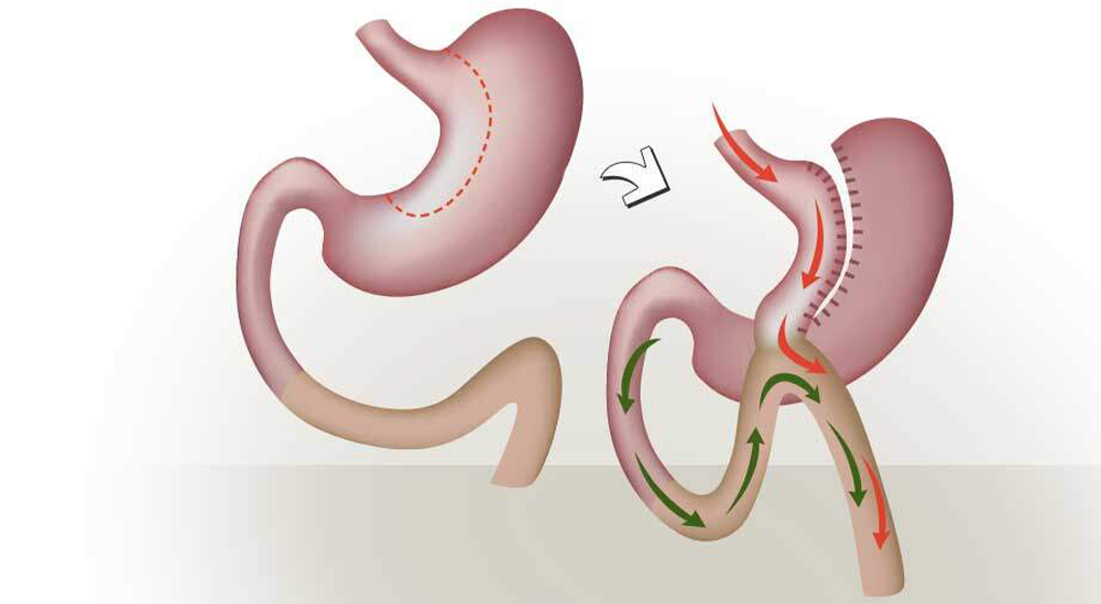 Mini-Gastric Bypass