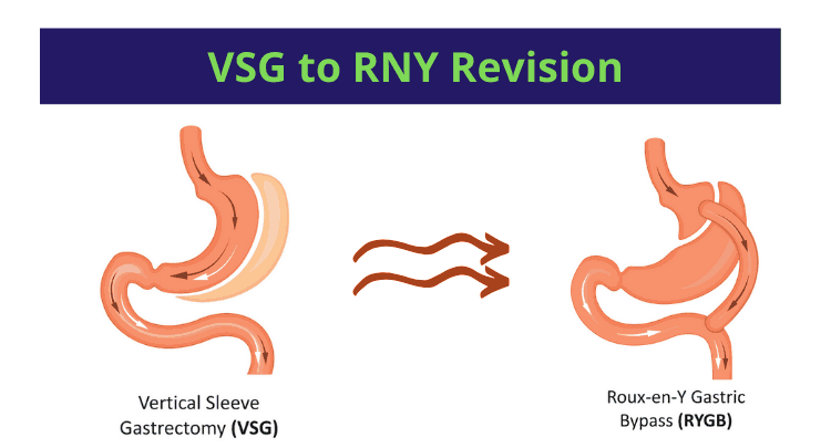 Gastric Sleeve Revision