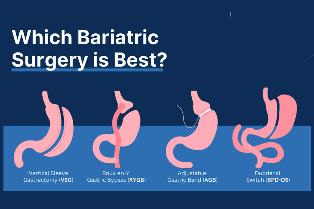 What are the advantages of gastric sleeve over gastric bypass ?