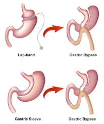 Revisional Bariatric Surgery