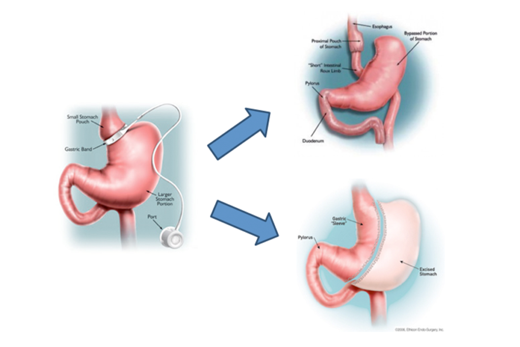 Gastric Band Revision