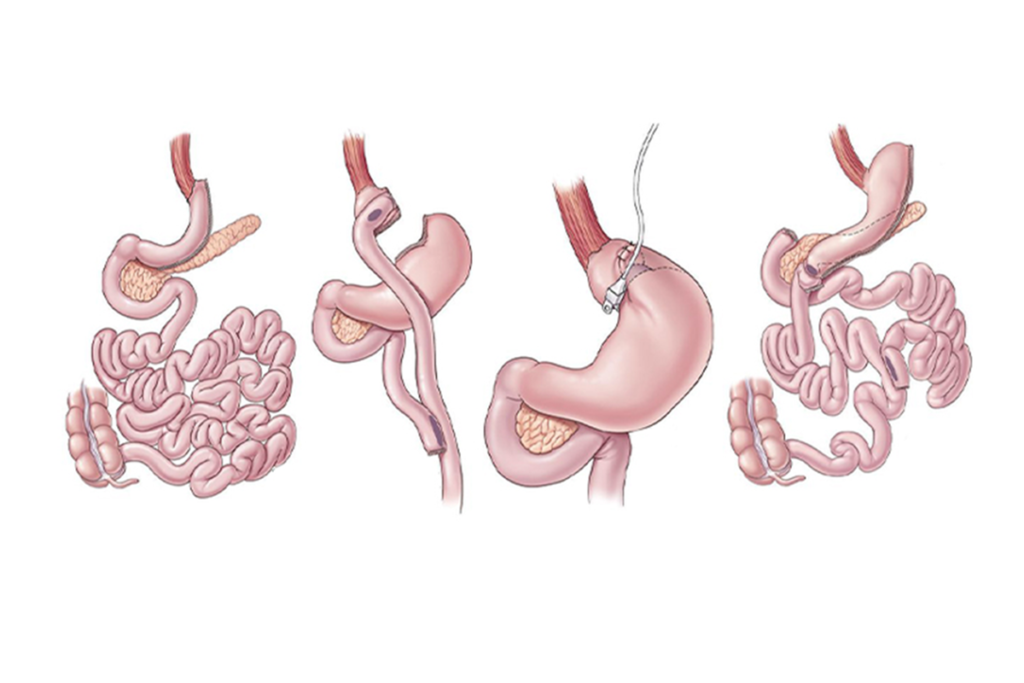 What is Obesity Surgery?