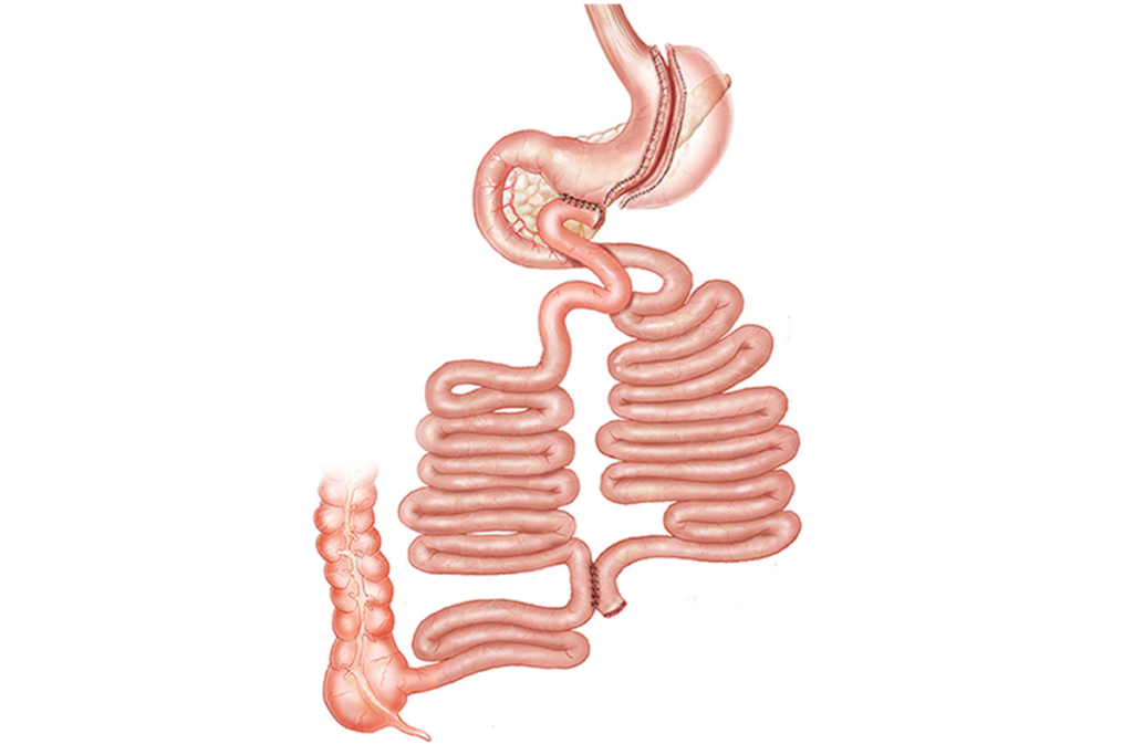 Transit Bipartition Surgery