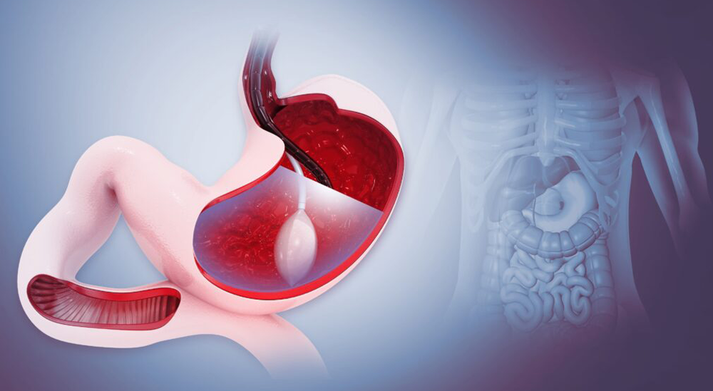 Gastric Balloon