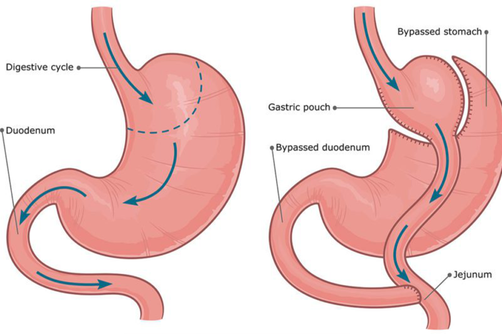 Gastric Bypass