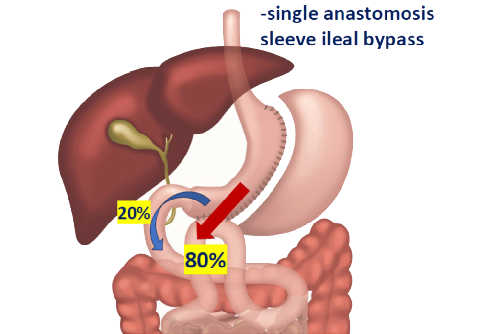SASI Bypass Surgery