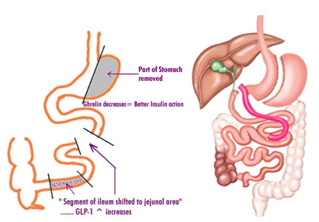 What is Ileal Interposition? 