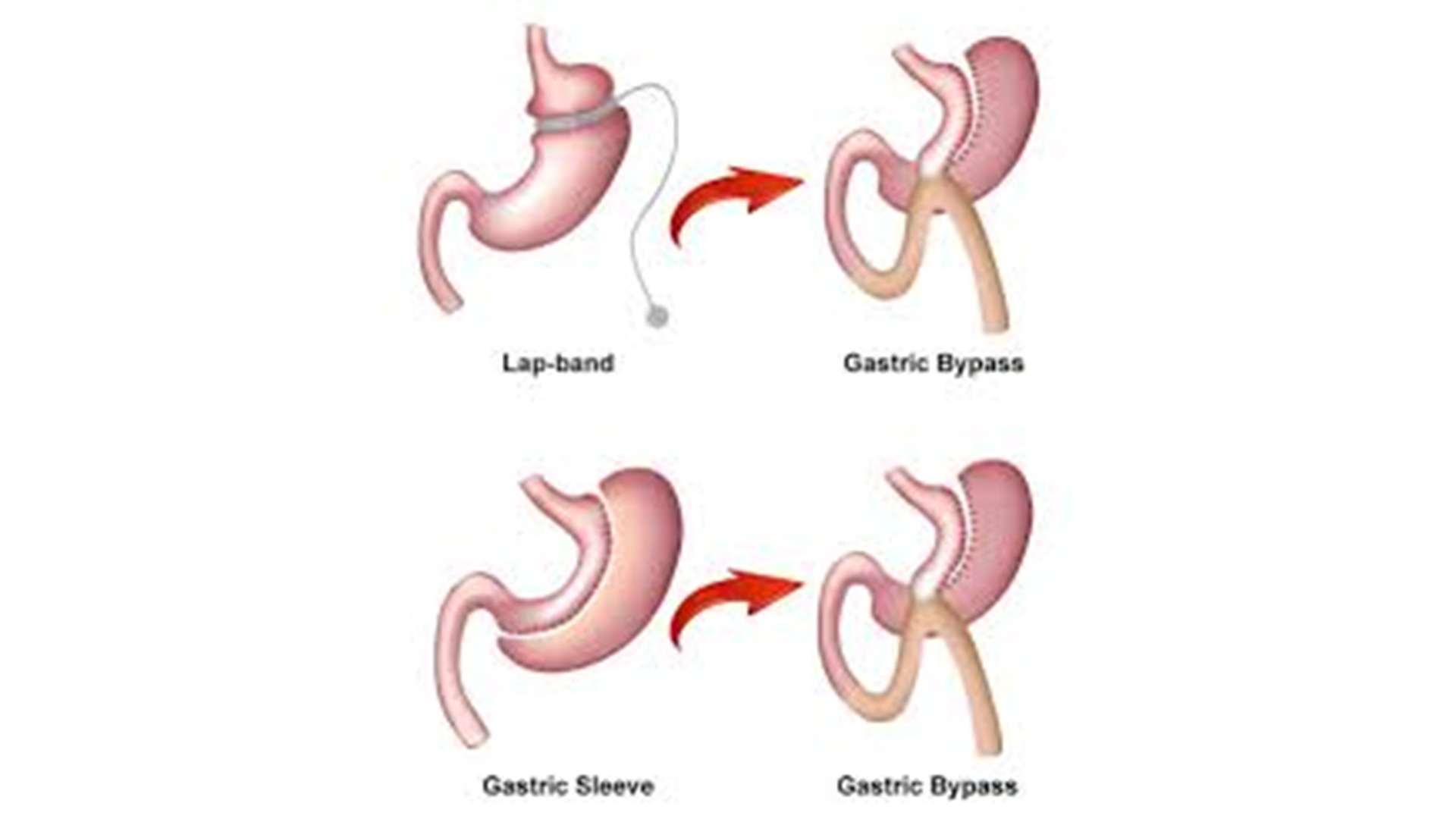 Was ist eine Revisions-Adipositaschirurgie und welche Methoden werden angewendet?